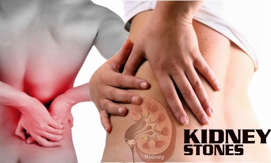 Kidney Stones - Prevention