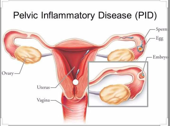 Pelvic Inflammatory Disease!