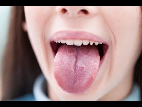 Know More About Burning Mouth Syndrome!