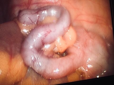 Laparoscopic Appendicectomy!