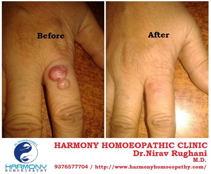 Polyp cured with homoeopathic medicine.