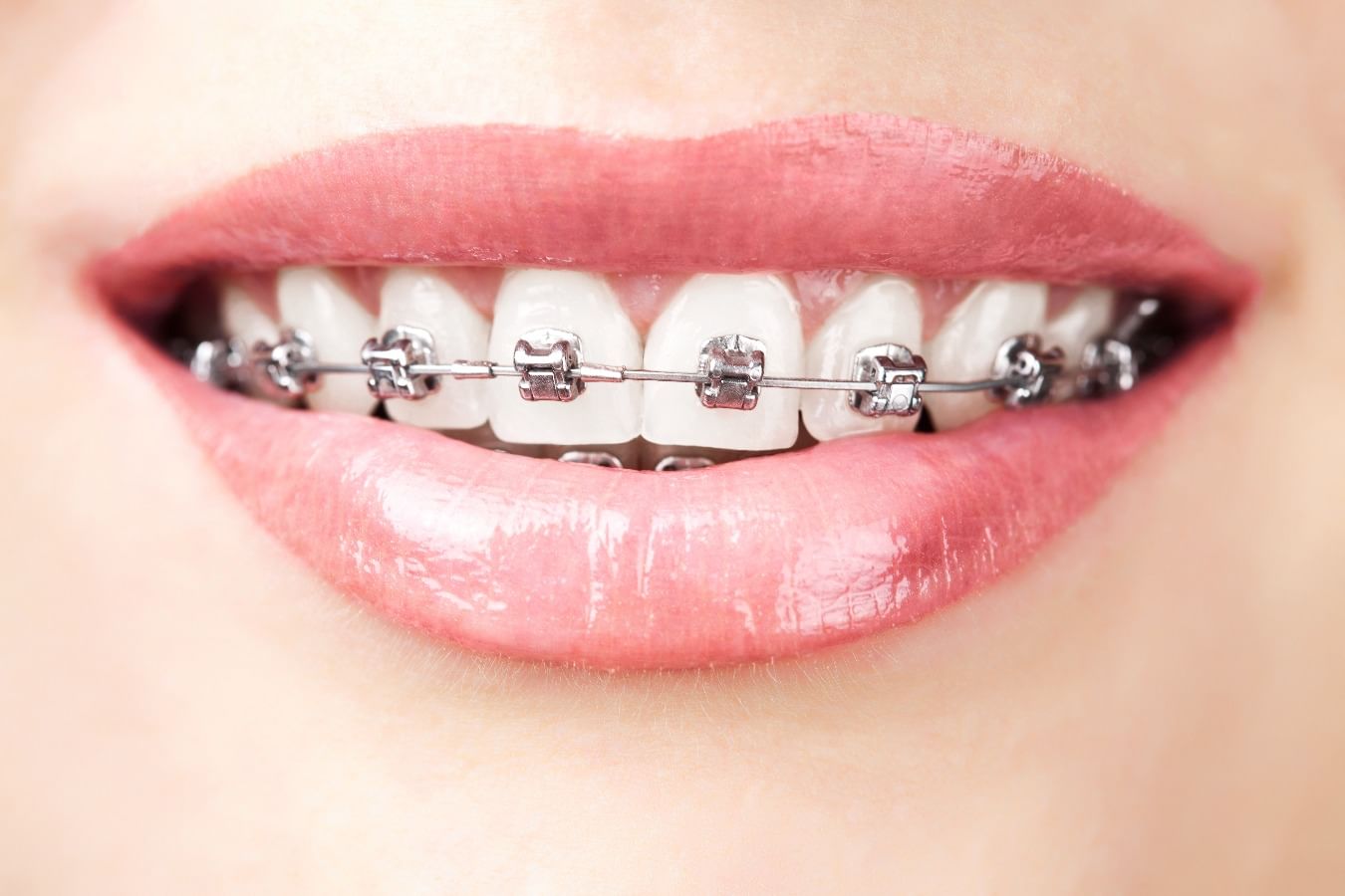 Orthodontic treatment for adults
