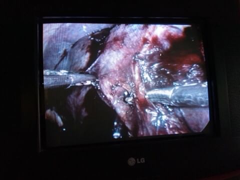 Laproscopy Gall Bladder Surgery