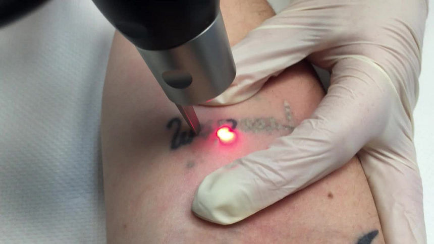 Laser Tattoo Removal