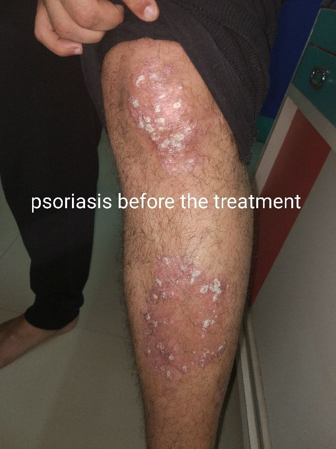 Psoriasis , Before And After The Treatment
