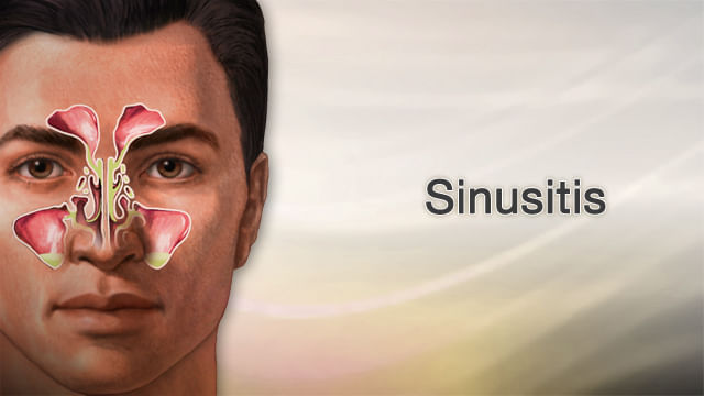 Sinusitis and Homeopathy