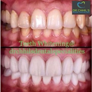 How To Keep Teeth White After Teeth Whitening Procedure?