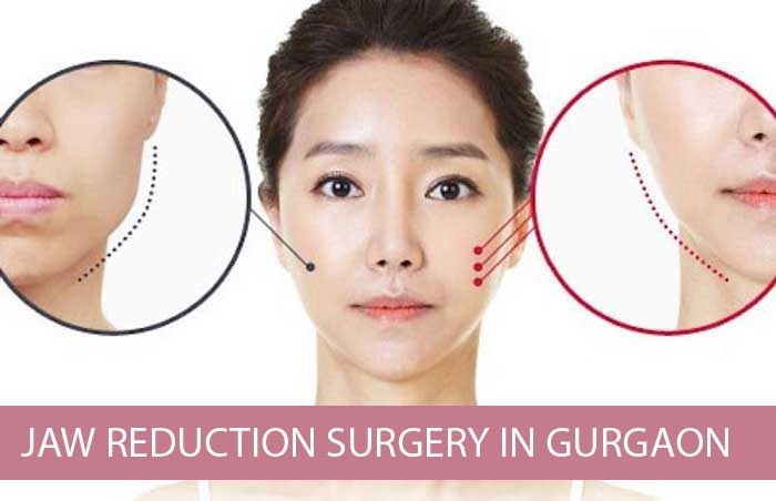 Jaw Reduction Surgery In Gurgaon