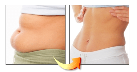 Tummy-Tuck Surgery For a Flat Stomach