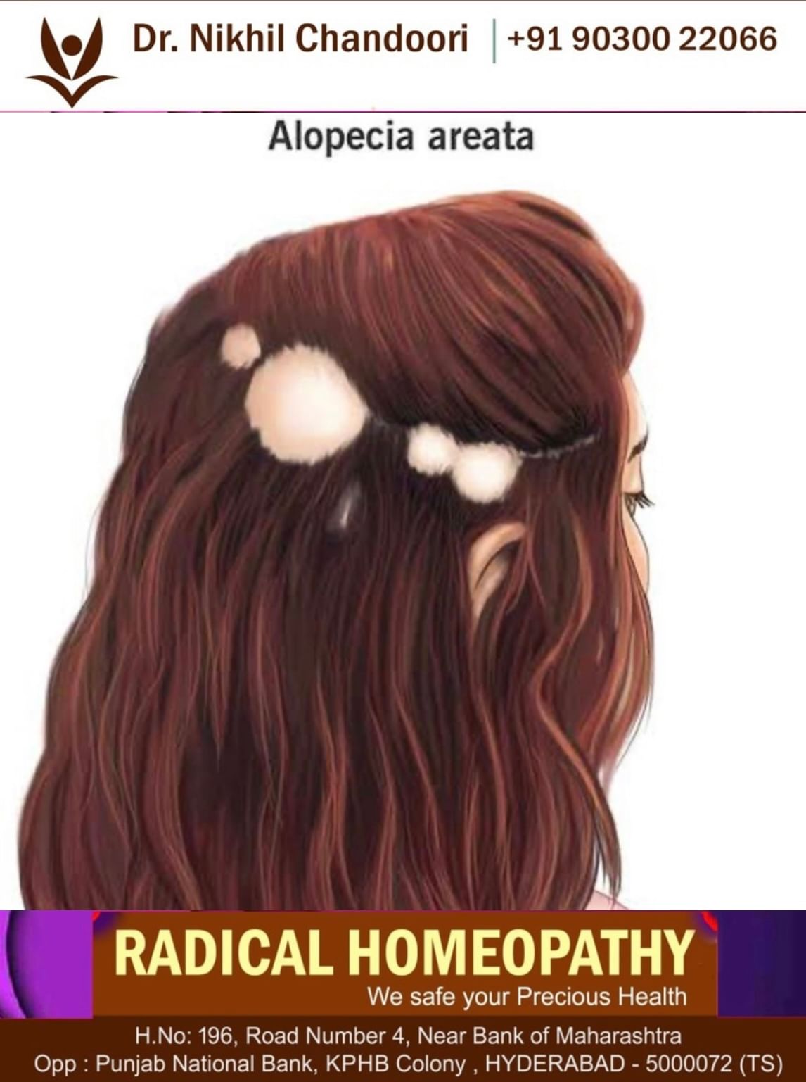 Alopecia areata.