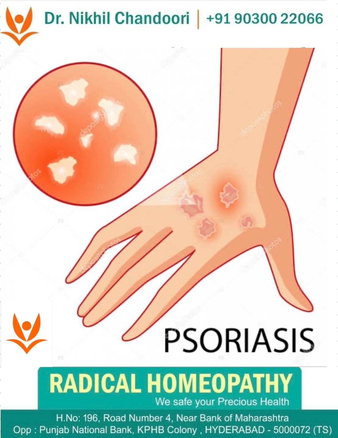 Best Psoriasis Treatment #Radicalhomeopathy