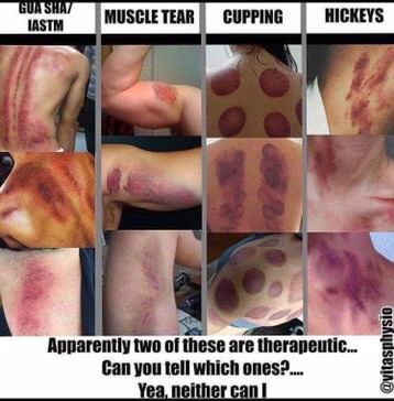 #cupping