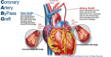 Guidance for CAD, Heart Patients undergoing CABG