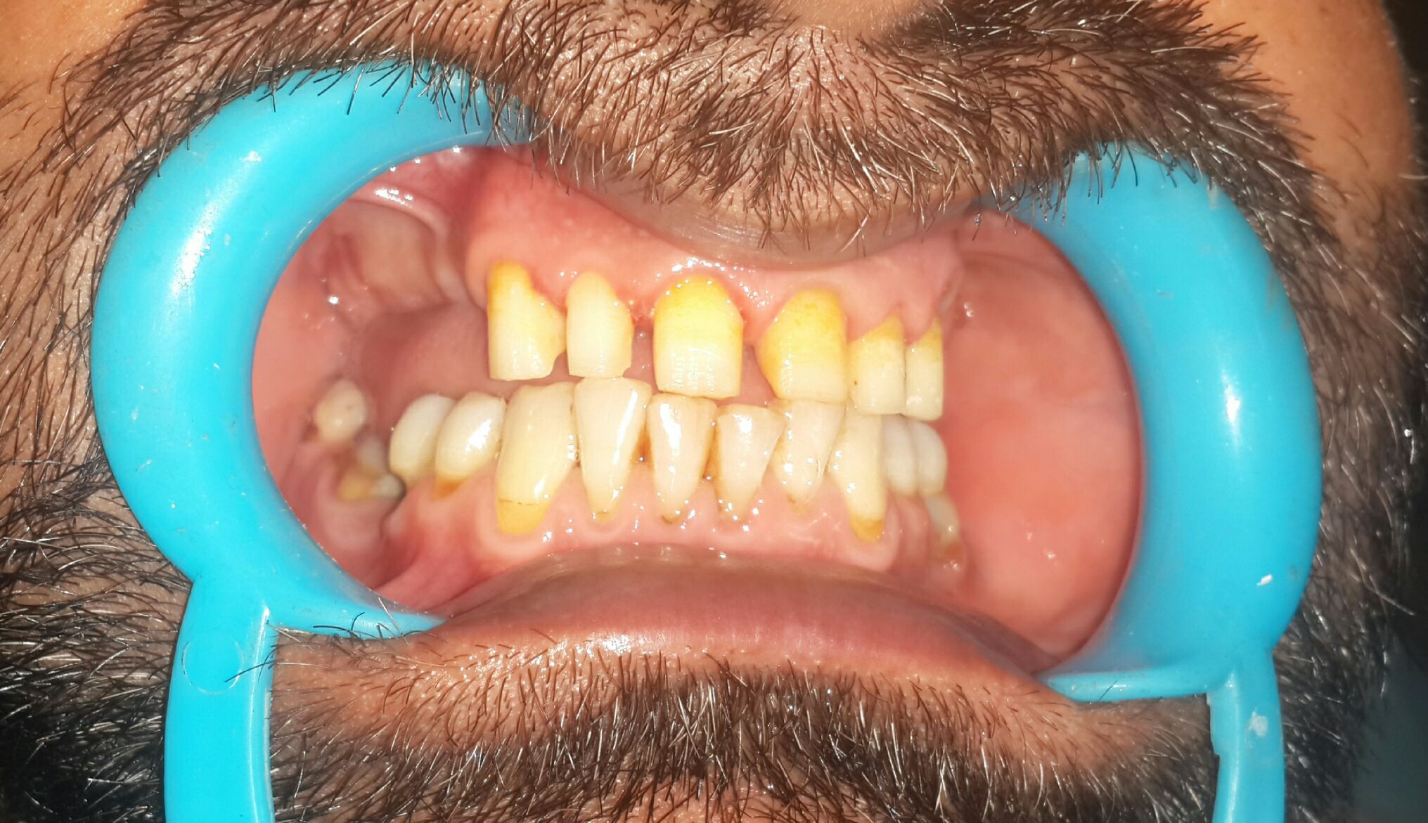 Prosthodontic rehabilitation
