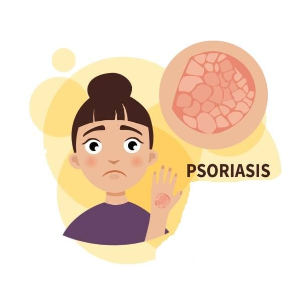 Psoriasis - The Skin Troublemaker!