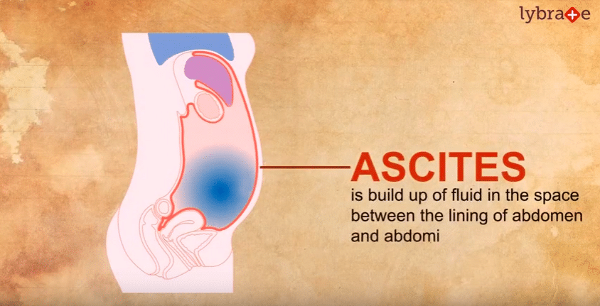 Ascites - What Is IT?