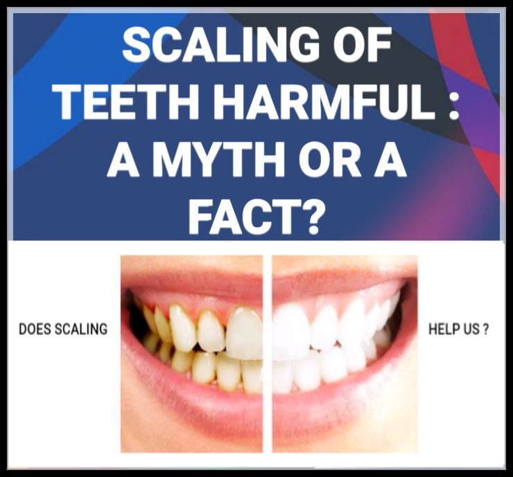 Scaling Of Teeth is Harmful : Dental Myths Or Facts About Scaling Procedure
