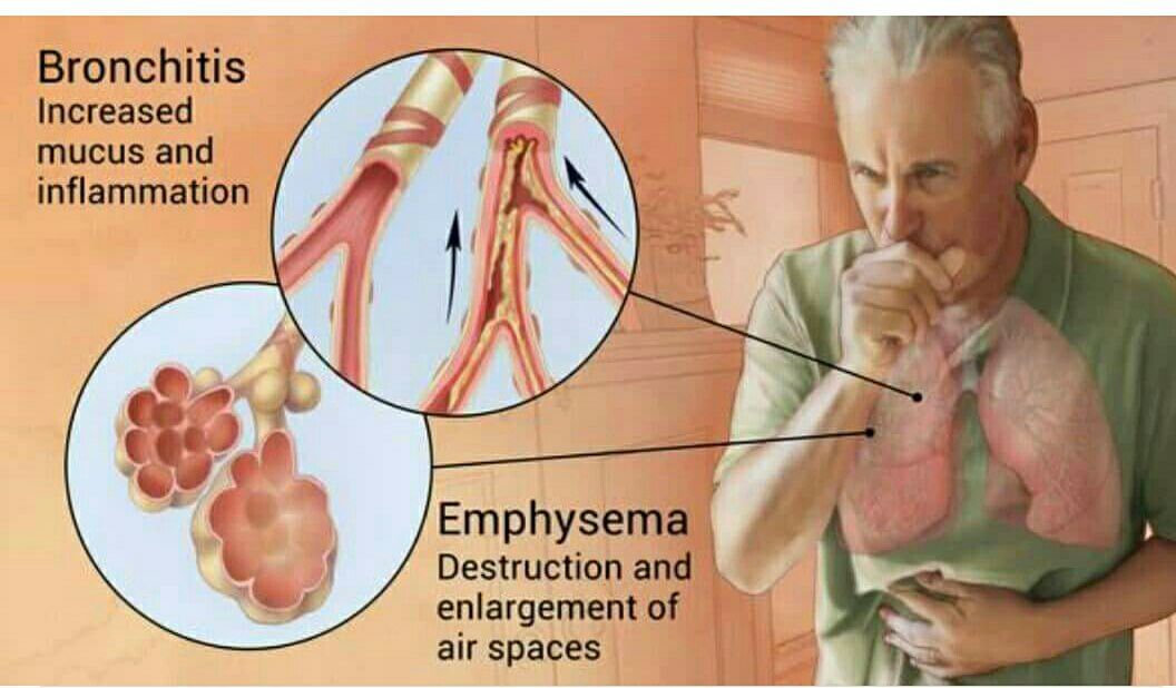 Know About COPD!