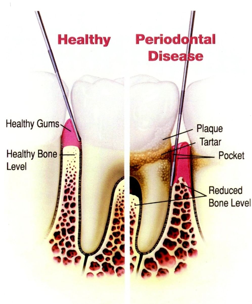 Healthy Gums - Healthy Teeth!