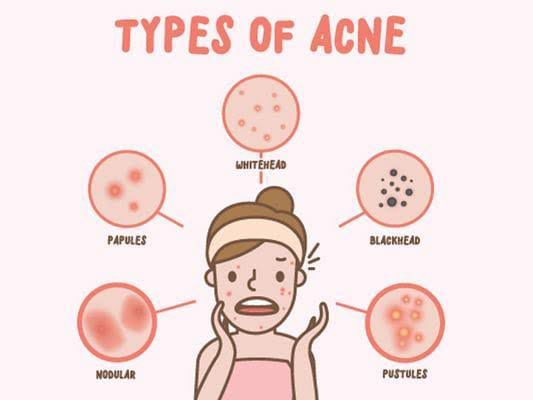 Know More About Acne!