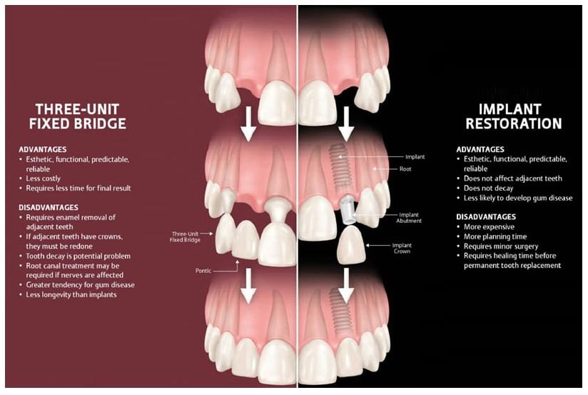 Dental Bridge vs Dental Implants