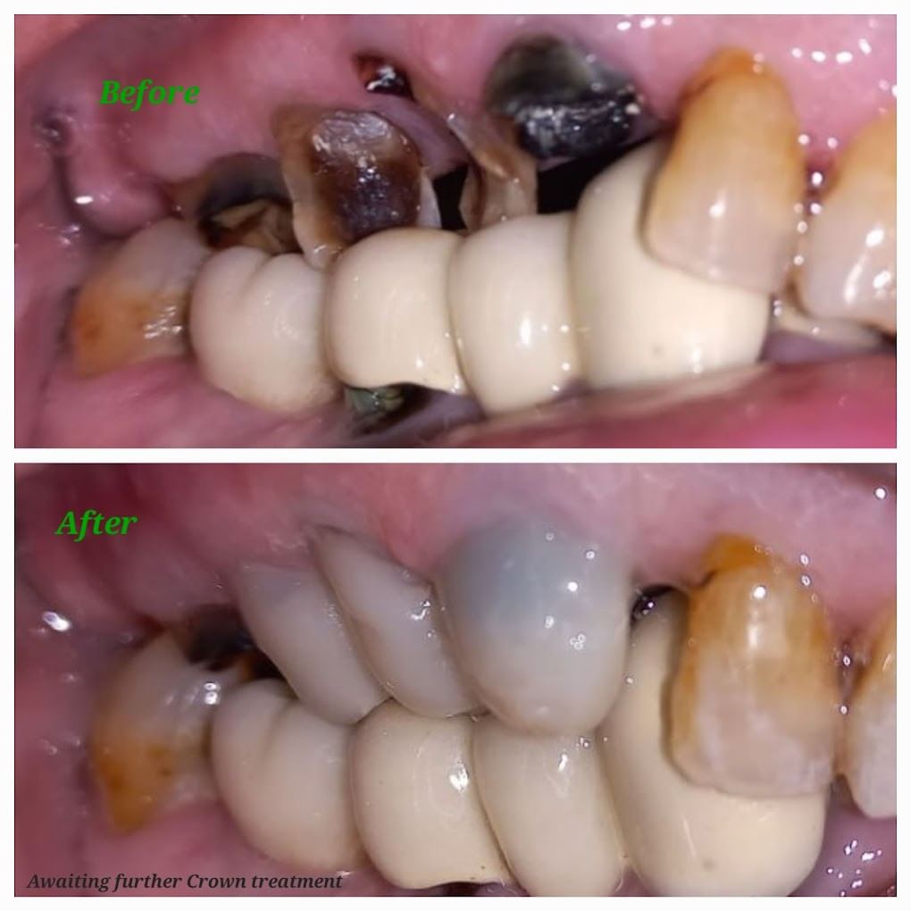 Saving hopeless teeth with Post & Core