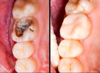 Difference between Dental fillings
