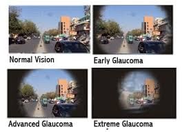 Glaucoma - A Silent Killer Of Eye Sight!