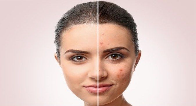 Acne (Pimples)- Myths And Facts