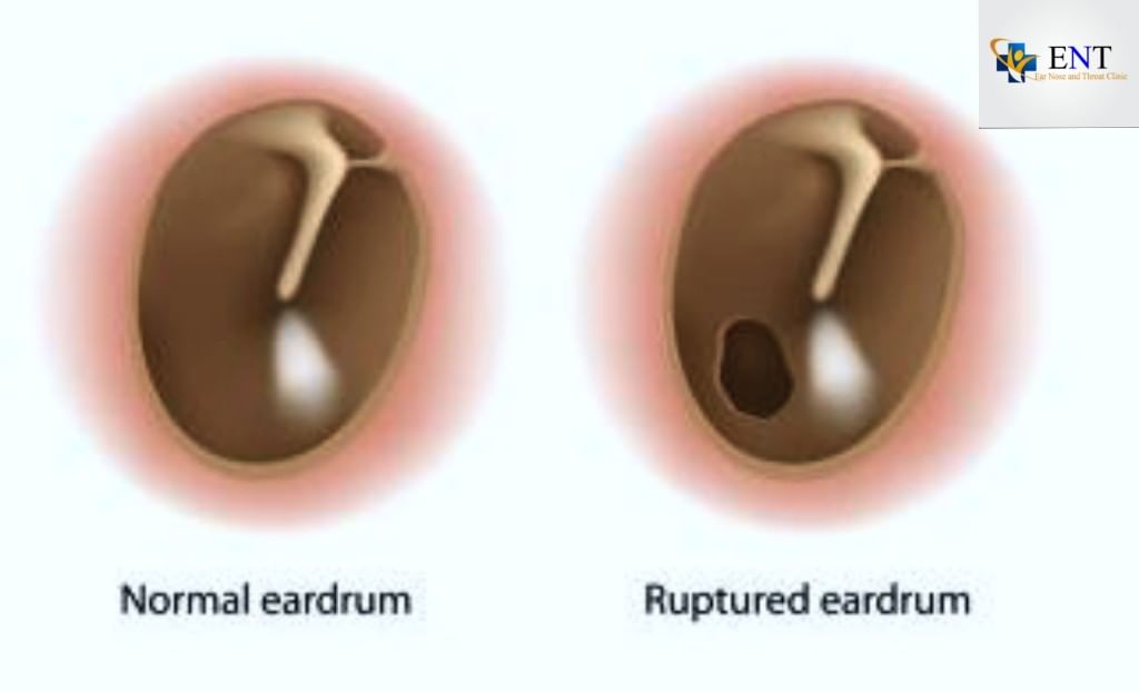 Do You Have A Ruptured Eardrum?
