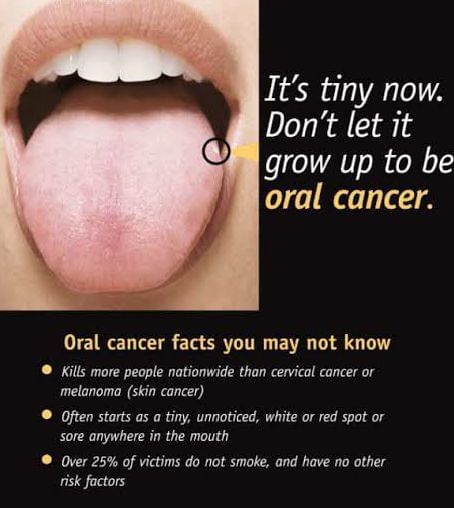 Oral Cancer - Lesser Known Facts!