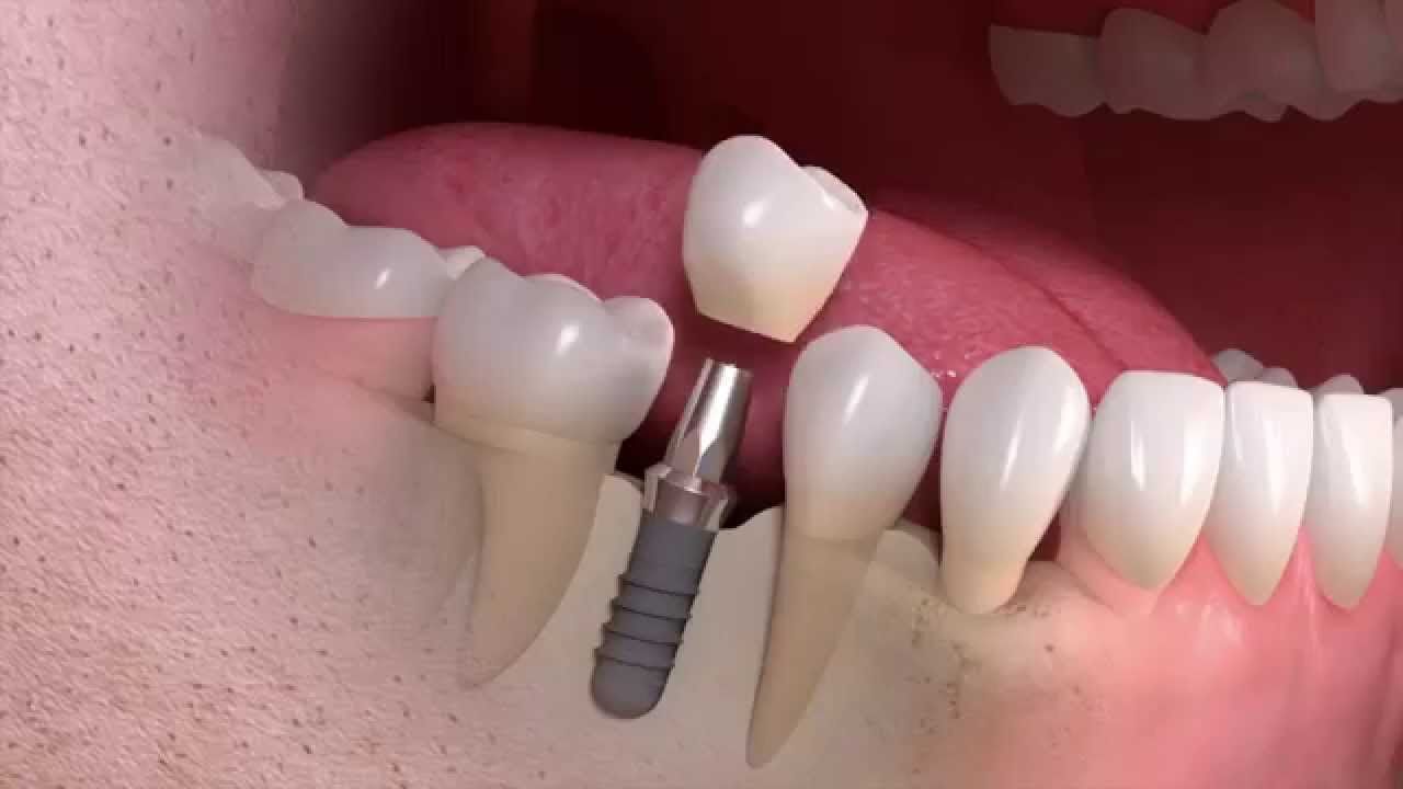 Dental Implants - Know More About Them!