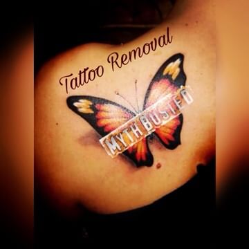 Tattoo Removal Myths Busted