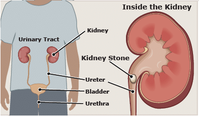 Kidney Stones - Symptoms