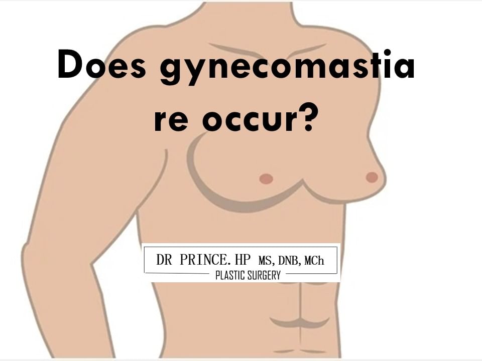 Does gynecomastia re occur?