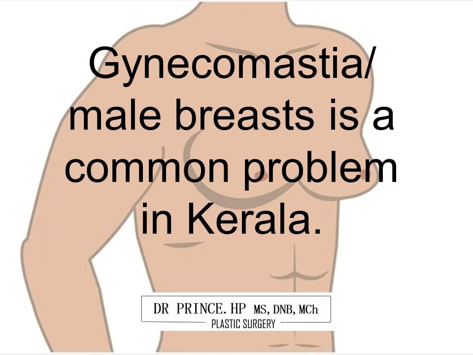 Gynecomastia/ male boobs is a increasing condition in Kerala