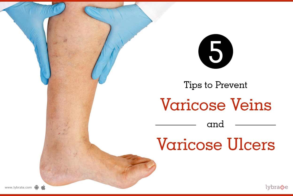 5 Tips To Prevent Varicose Veins and Varicose Ulcers