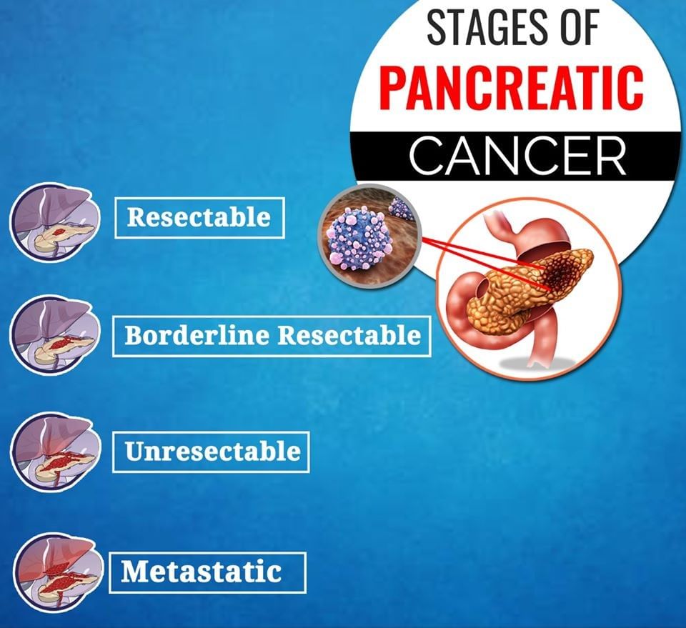 Staging of Pancreatic Cancer