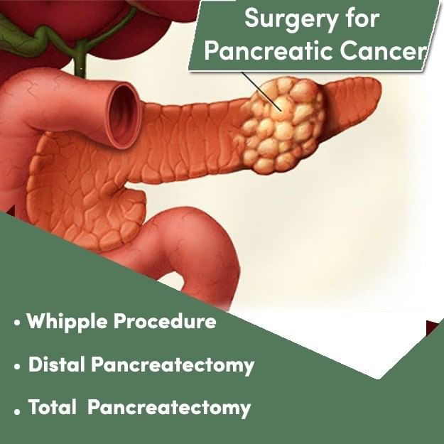 Surgery for Pancreatic Cancers