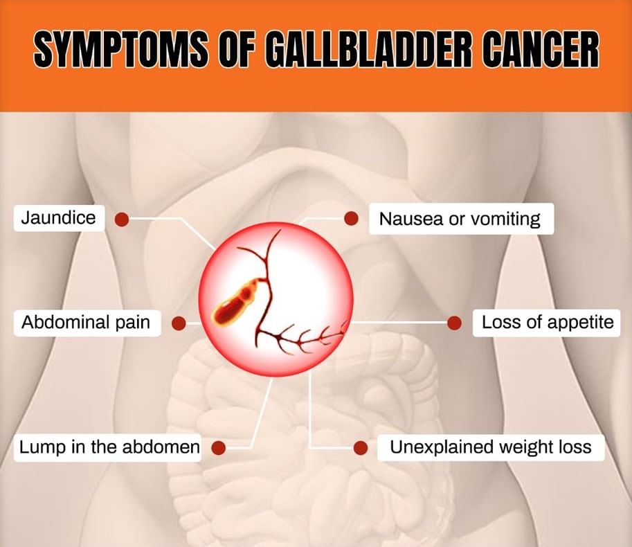 Gallbladder Cancer - Signs And Symptoms!
