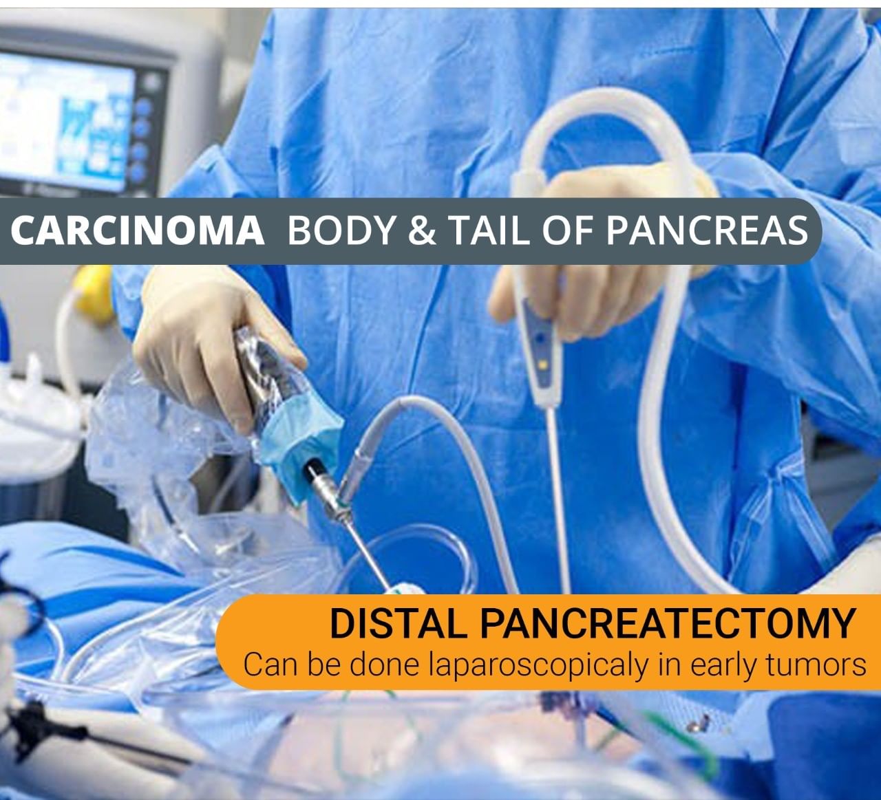 Surgery For Pancreatic Body And Tail Tumours!