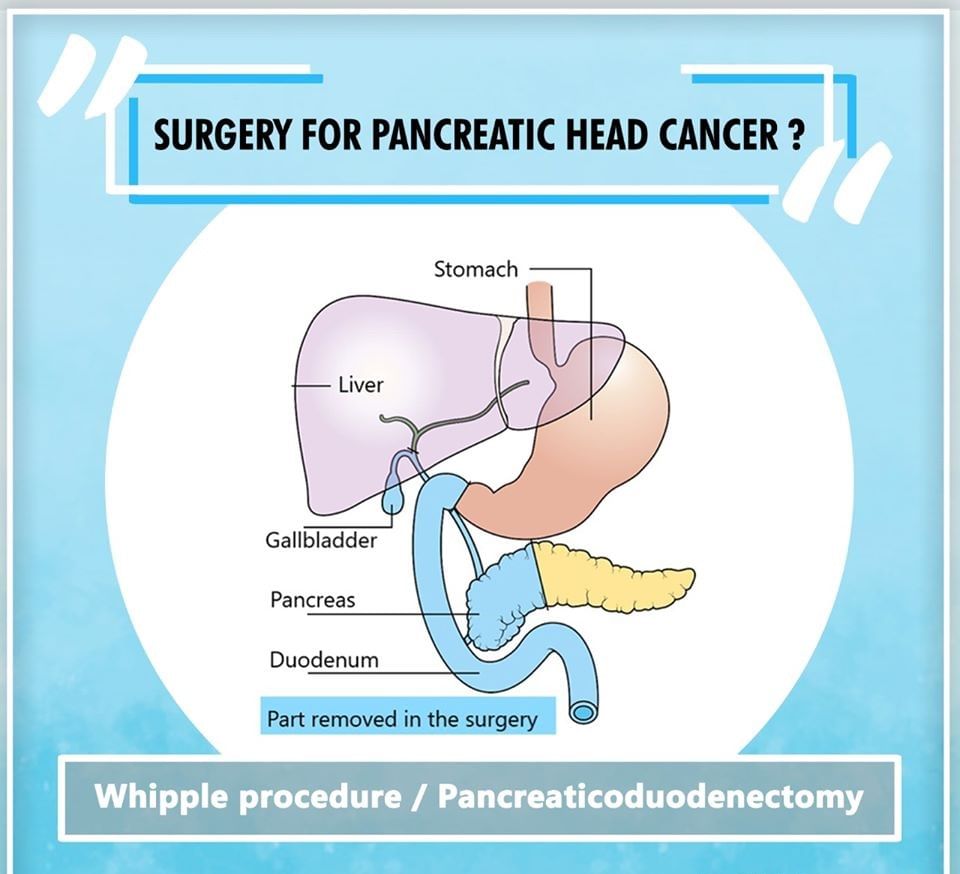 Whipple Procedure or Pancreaticoduodenectomy
