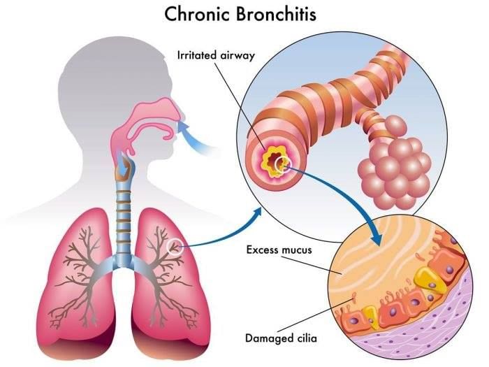 Homeopathy For Acute And Chronic Bronchitis! - By Dr. Maruboina ...