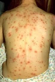 Chickenpox (Laghu Masurika) - Things You Should Know About It!
