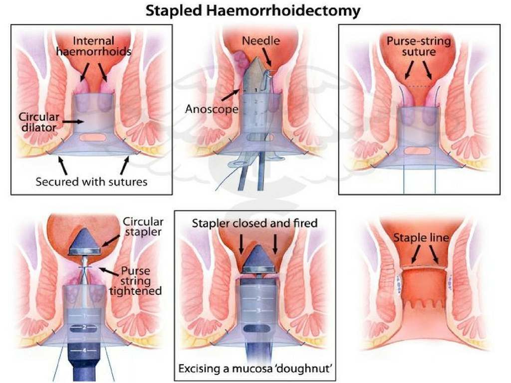 Stapled Hemorrhoidectomy For Piles