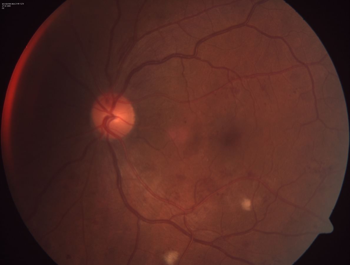 Are you diabetic, get screened by Ophthalmologist for diabetic retinopathy
