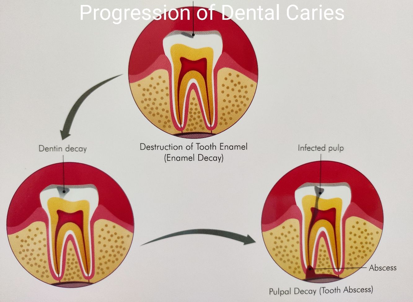 Tooth Cavity- Know More About It!