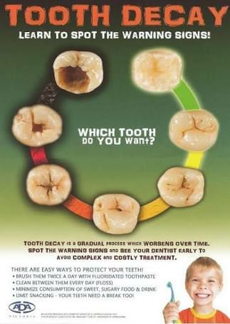 Warning Signs of Tooth Decay