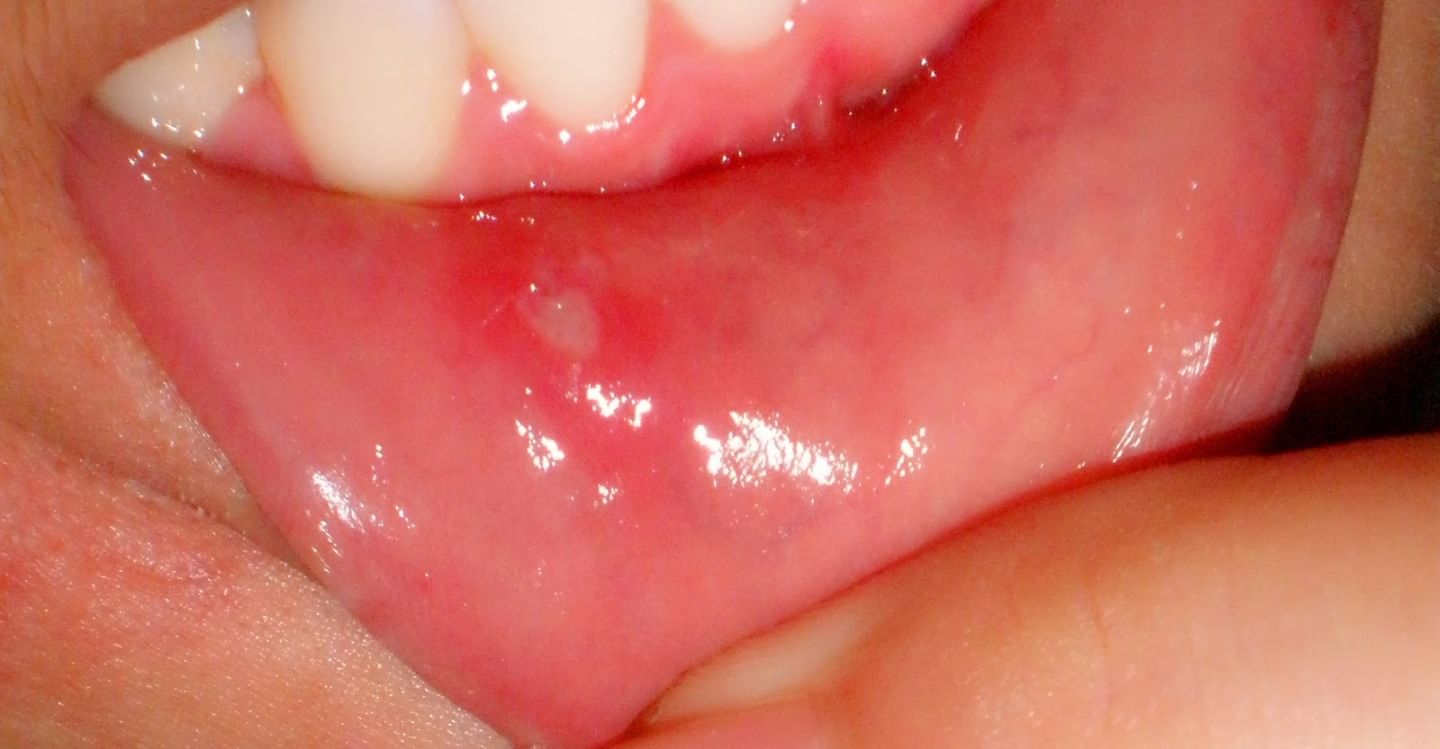Tip for Mouth Ulcers