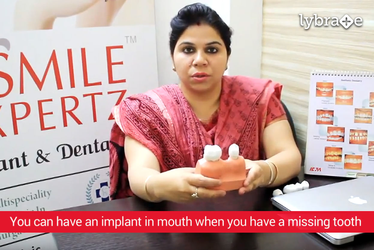 About Tooth Implants